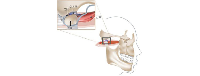 턱관절원인이미지