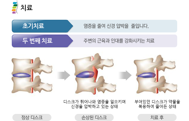 척추치료타이틀